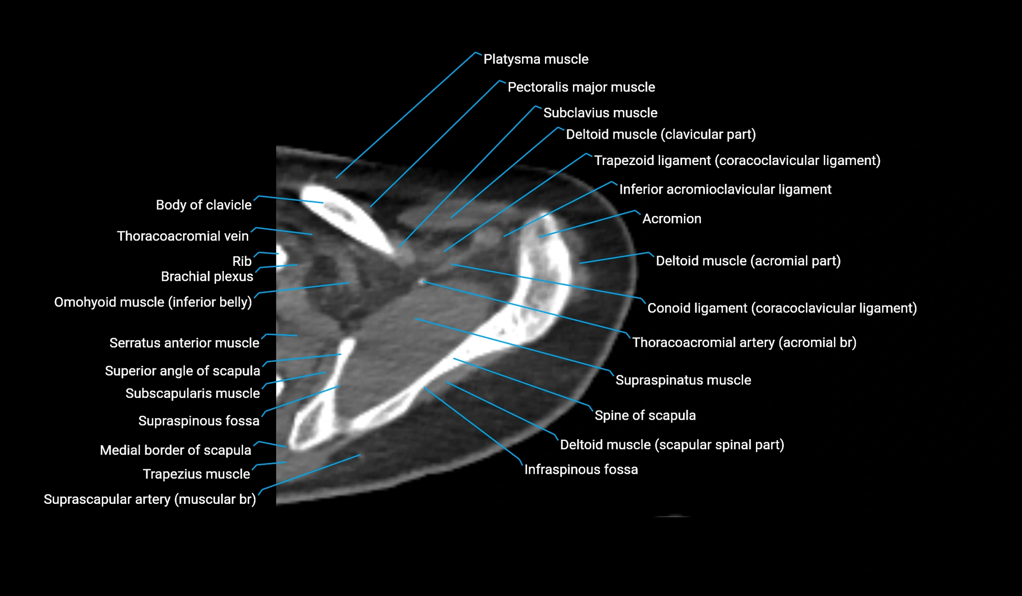 CT upper arm axial  cross sectional anatomy labelled radiology image -00066.webp